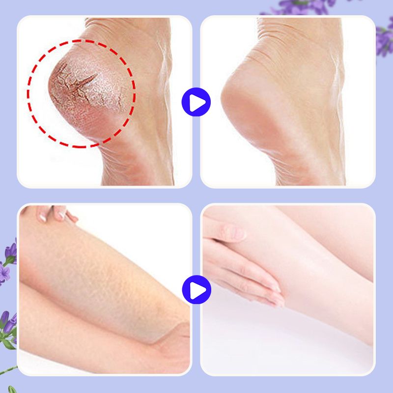 🔥Nourishing and repairing dry and cracked skin Look 20 years❤️ younger in an instant Limited time 77% off Come and give your feet a fresh new look!